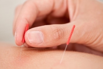 Chiropractor applying dry needles to patients muscles